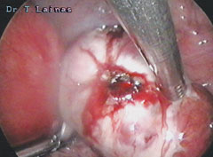 Small ovarian endometrioma (laparoscopic image).
